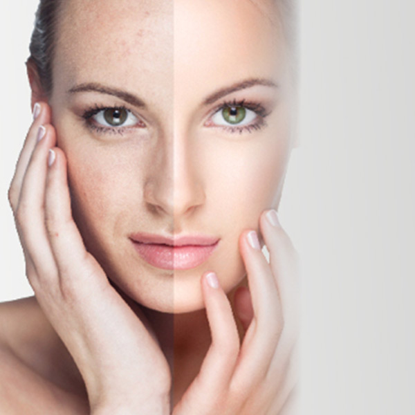 Female Model’s face with & without laser skin rejuvenation Female Model's face with & without laser skin rejuvenation